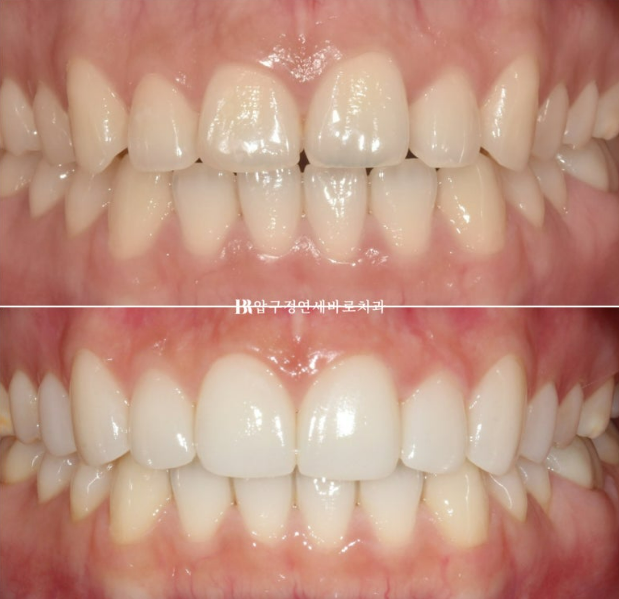 How to Create a Beautiful Smile Line? | A Real Case of Changing a Smile with No-Prep Laminates image 15