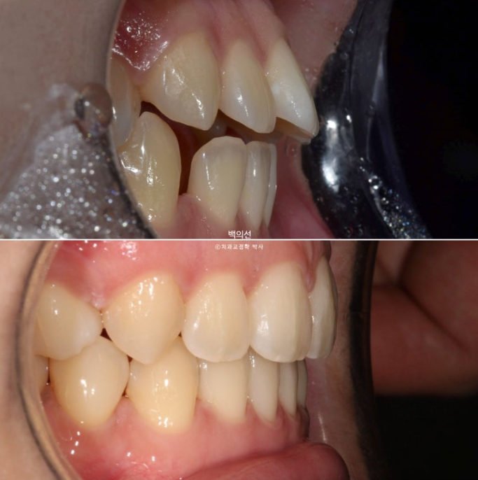 돌출입 교정 인비절라인 발치 교정 개방교합 치료 후기 관련 이미지 24