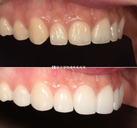 Non-Prep Veneer Review | A Case Naturally Improving Gaps Between the Front Teeth and the Smile Line image 11