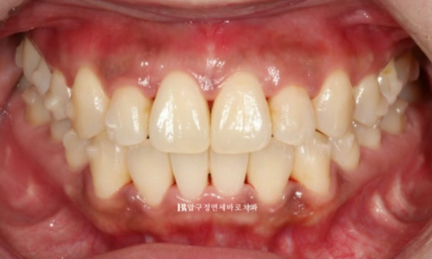인비절라인 덧니 교정 치료기간 9개월 후기 관련 이미지 6