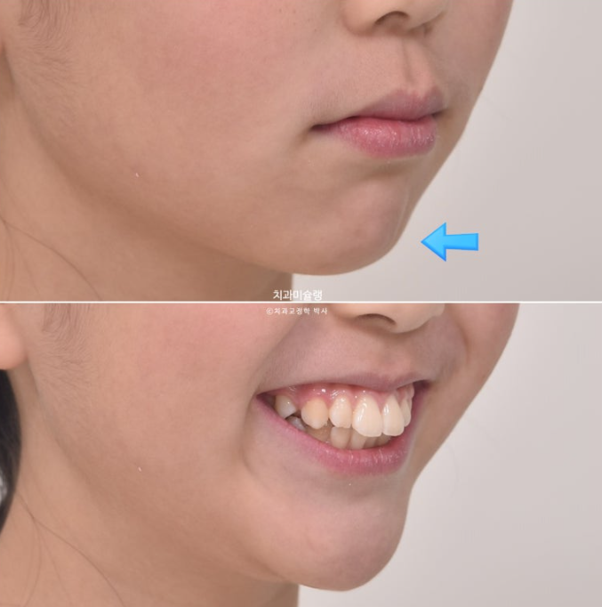 돌출입 비발치 어린이 교정 입술부전증 호두주름 호두턱 토끼이빨 인비절라인퍼스트 관련 이미지 6