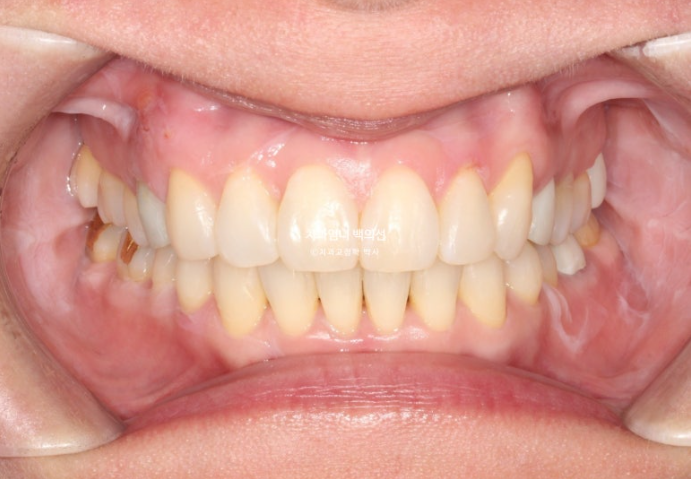 50대 캔팅 교합평면 기울어짐 덧니 교정 인비절라인 라이트 교정? 관련 이미지 8