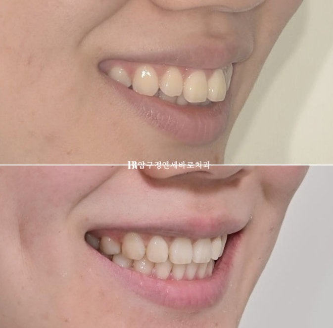 Gummy Smile Correction, Gummy Smile Orthodontics, Rabbit Teeth Correction image 19