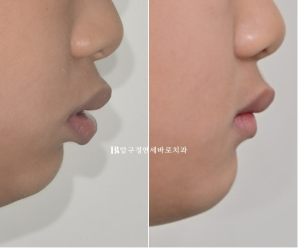 인비절라인 퍼스트 후기 | 어린이 교정으로 영구치 교정까지 한 번에 마무리한 실제 사례 관련 이미지 21