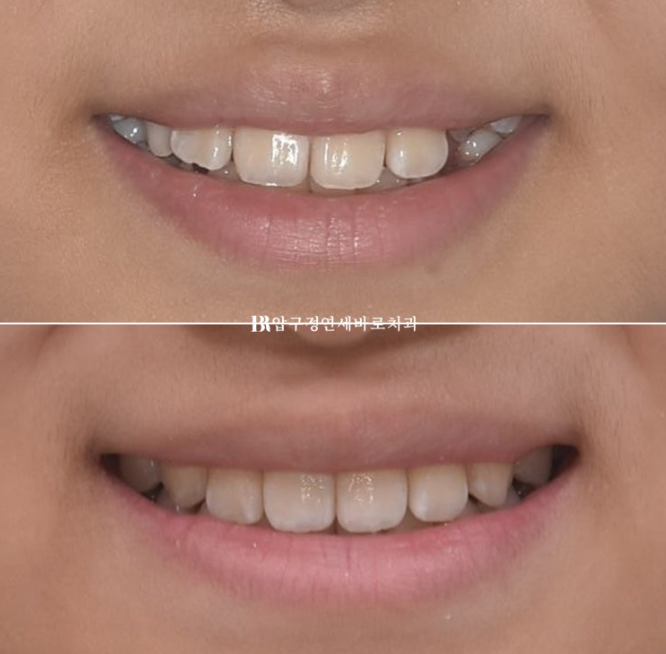 Simultaneous Arch Expansion and Teeth Alignment for Elementary School Children with Invisalign｜Invisalign First image 17
