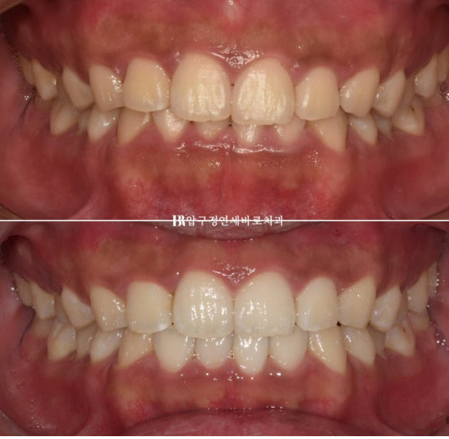 Can Invisalign Lite Correct Deep Bite and the Occlusal Plane? | A Real Case With 14 Aligners Over 4 Months image 9