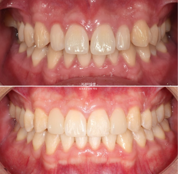 비대칭 비발치 거미스마일 잇몸미소 중심선 가위교합치료 무삭제 라미네이트 관련 이미지 24