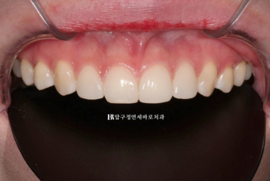 왜소치·원추형 치아, 교정보다 무삭제 라미네이트가 좋은 이유 | 앞니 벌어짐 치료 후기 관련 이미지 7