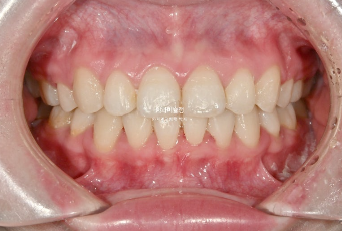 심한 돌출입 입술부전증 호두주름 발치교정 치료 관련 이미지 10