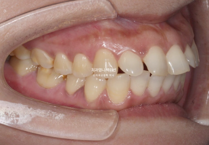 40대 인비절라인 라이트 앞니 벌어짐 뻗침 돌출 치료 관련 이미지 3