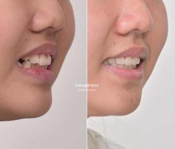 덧니 반대교합 과개교합 인비절라인 퍼스트 악궁확장 어린이 교정 관련 이미지 25