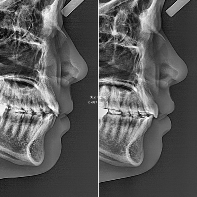 유학생 치아교정 해외거주 한국에서 치아교정? 관련 이미지 23