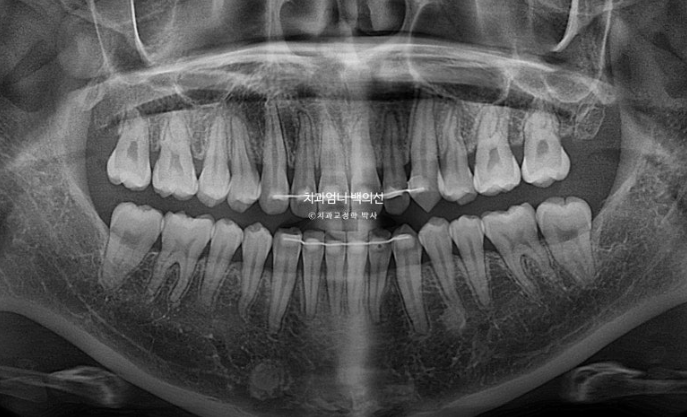 인비절라인 교정 비발치 비대칭 덧니 중심선 선천적 결손치 교정? 관련 이미지 20