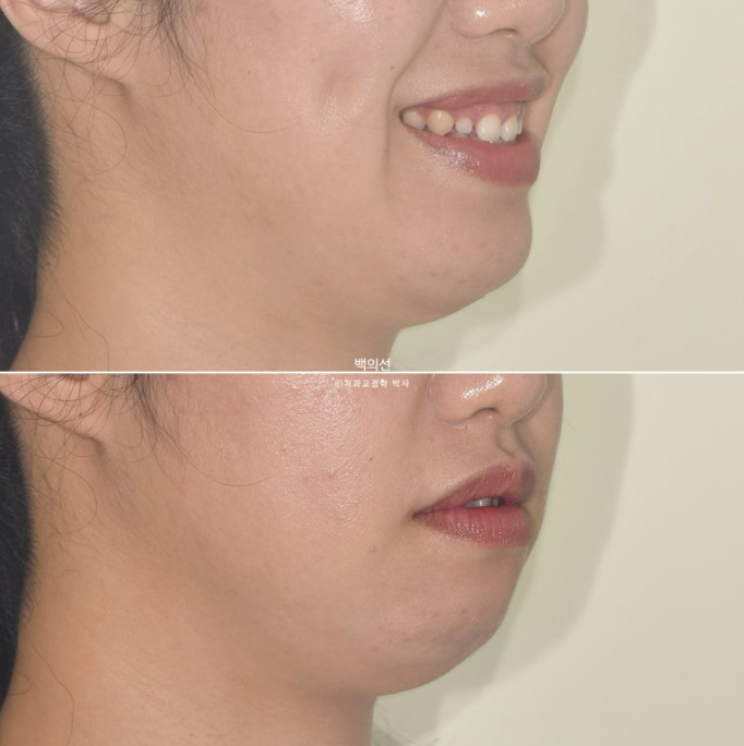 30대 치아교정 돌출입 교정 :: 잇몸미소 거미스마일 교정 입술부전증 결손치 무턱교정 관련 이미지 8