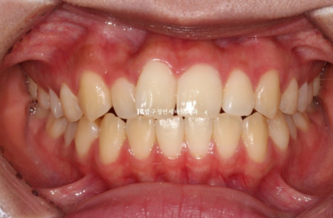압구정 교정치과 덧니 부분교정 단기교정 후기 관련 이미지 2