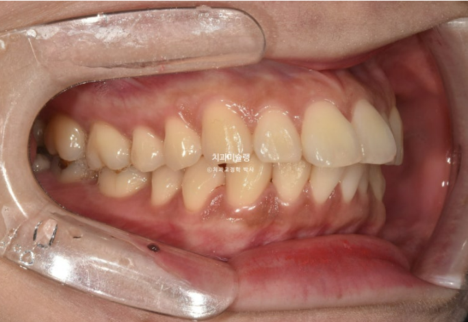 비발치 돌출입 인비절라인 교정 가위교합 중심선 맞추기 관련 이미지 3