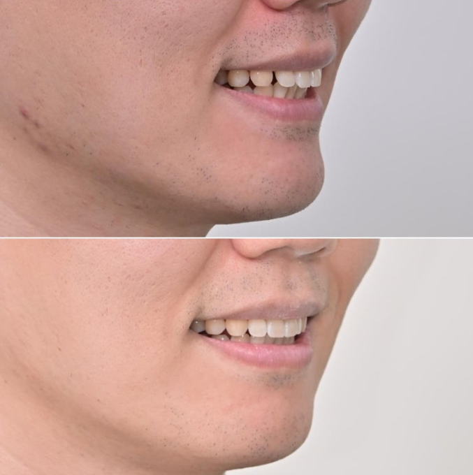 가위교합 벌어짐 중심선 과개교합 인비절라인 라이트 교정 관련 이미지 20