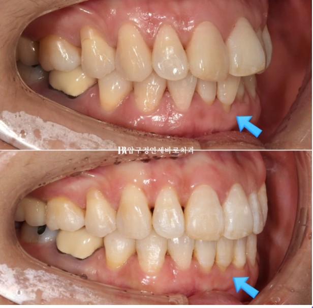 50대 치아교정 인비절라인 라이트 앞니교정 치료 후기 관련 이미지 1