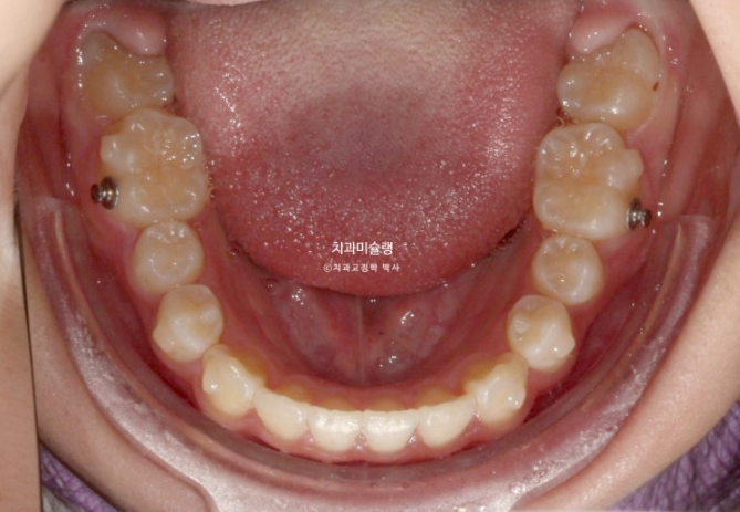 돌출입 비발치 어린이 교정 입술부전증 호두주름 호두턱 토끼이빨 인비절라인퍼스트 관련 이미지 11