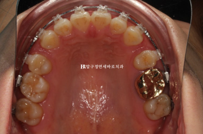 돌출입 발치교정으로 거미스마일&middot;잇몸미소&middot;입술부전까지 개선한 사례｜입동굴 변화까지 확인해보세요 관련 이미지 6