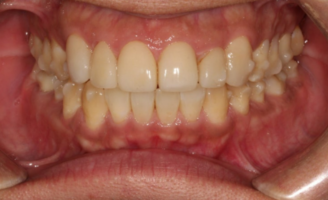 40대 치아교정 인비절라인 라이트 덧니 교정 어금니 교합 부작용 관련 이미지 7
