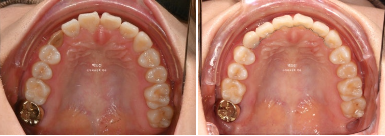 매복 결손 잔존유치 라미네이트 크라운 캔팅 인비절라인 라이트 치료 관련 이미지 18