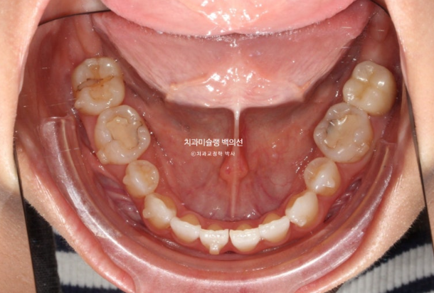 인비절라인 익스프레스 재교정 블랙트라이앵글 치간 삭제 치료기간 6개월 재제작 1회 관련 이미지 10