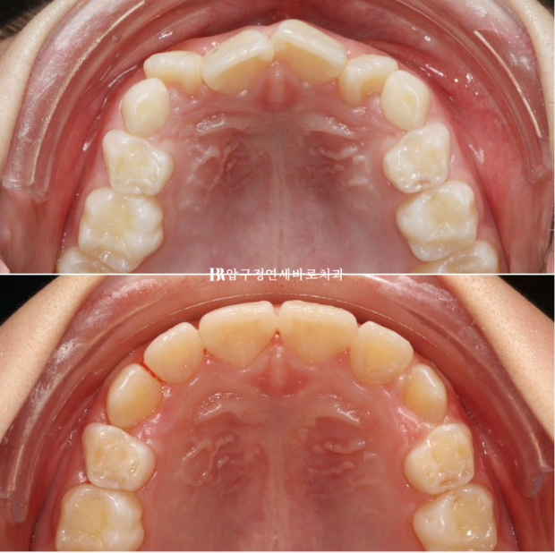 소아 투명교정 인비절라인 퍼스트 후기 기록 관련 이미지 17