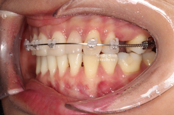 옥니 역교정 재교정 무턱 교정 치료기간 1년 10개월 관련 이미지 9