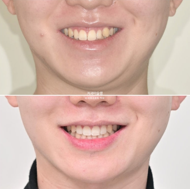 비대칭 비발치 거미스마일 잇몸미소 중심선 가위교합치료 무삭제 라미네이트 관련 이미지 29