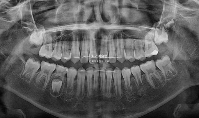 어린이 돌출입 교정 무턱 투명교정 인비절라인 퍼스트 관련 이미지 28