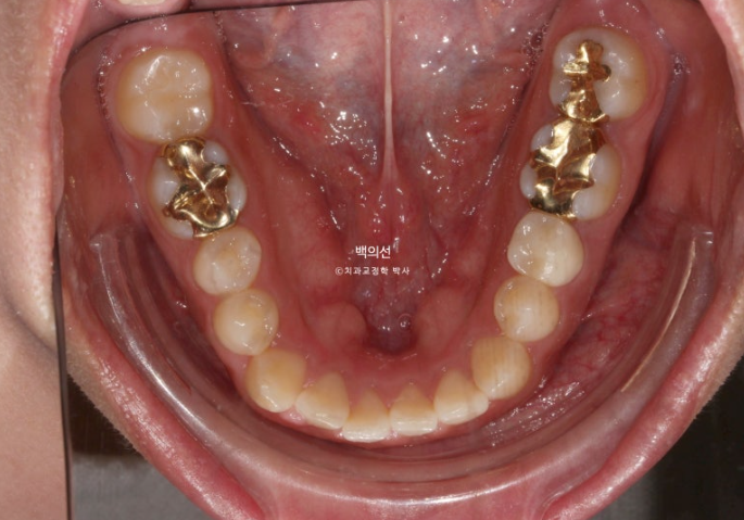 30대 치아교정 돌출입 교정 :: 잇몸미소 거미스마일 교정 입술부전증 결손치 무턱교정 관련 이미지 7