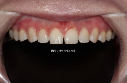 왜소치·원추형 치아, 교정 대신 무삭제 라미네이트로 개선한 사례 관련 이미지 4