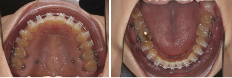 비수술 개방교합 클리피씨 30대 무삭제 라미네이트 치료기간 2년 관련 이미지 8