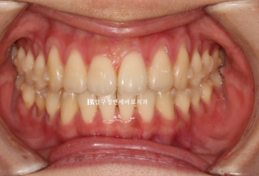 인비절라인 익스프레스 토끼이빨 교정 기간? 인비절라인 종류는? 관련 이미지 6