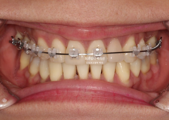 옥니 역교정 재교정 무턱 교정 치료기간 1년 10개월 관련 이미지 8