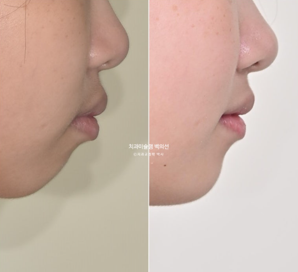 돌출입 무턱 인비절라인 발치교정 덧니 치료기간 1년 11개월 관련 이미지 18