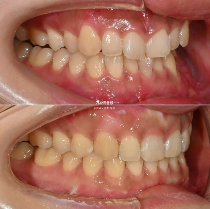 선수술 양악수술 비대칭 주걱턱 잇몸미소 치료 인비절라인 라이트 관련 이미지 18