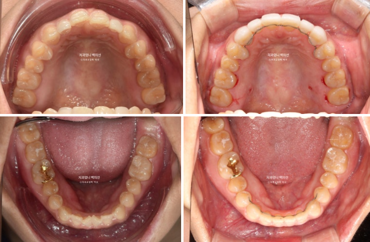 비수술 개방교합 클리피씨 30대 무삭제 라미네이트 치료기간 2년 관련 이미지 15