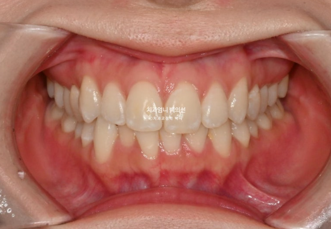 인비절라인 라이트 교정 앞니돌출 과개교합 덧니 교정 관련 이미지 2