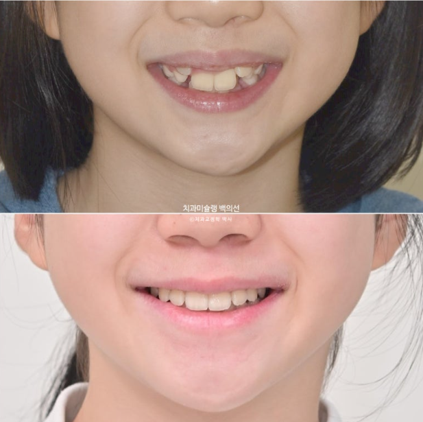 어린이 무턱 성장교정 덧니 인비절라인 퍼스트 악궁확장 치료기간 2년 관련 이미지 33