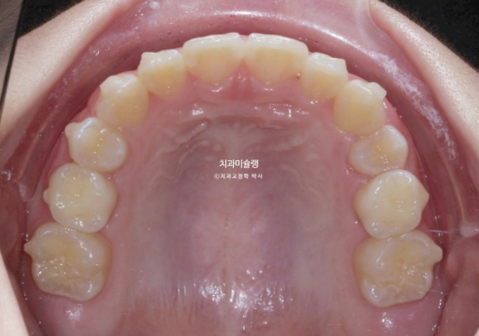 돌출입 비발치 어린이 교정 입술부전증 호두주름 호두턱 토끼이빨 인비절라인퍼스트 관련 이미지 10