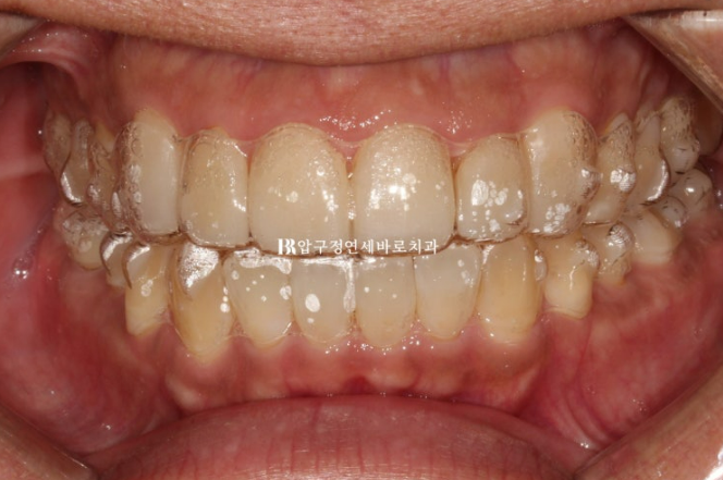 40대 치아교정 인비절라인 라이트 덧니 교정 어금니 교합 부작용 관련 이미지 6