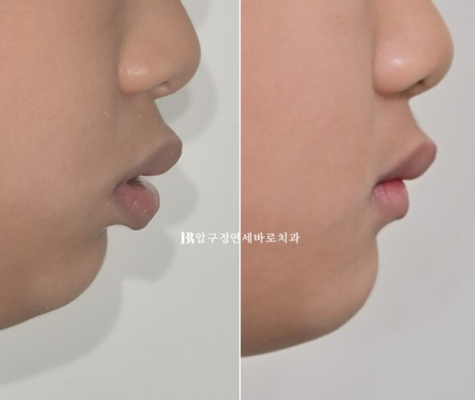 인비절라인 퍼스트만으로 영구치 교정까지 가능할까요?|소아교정 실제 사례 관련 이미지 21
