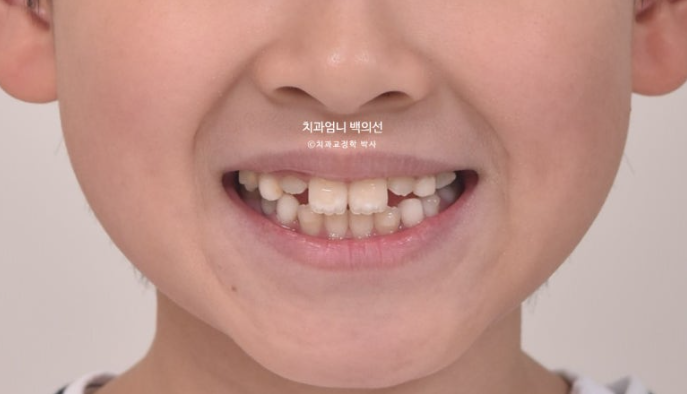 어린이 교정 인비절라인 퍼스트 비대칭 반대교합 어린이 성장 교정 관련 이미지 10