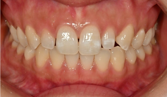 왜소치 반점치 (반상치)가 있는 경우 무삭제 라미네이트 치료 관련 이미지 2