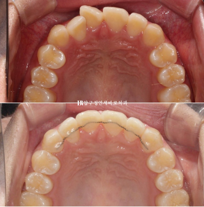 덧니교정 앞니부분교정 치간삭제 후기 관련 이미지 10