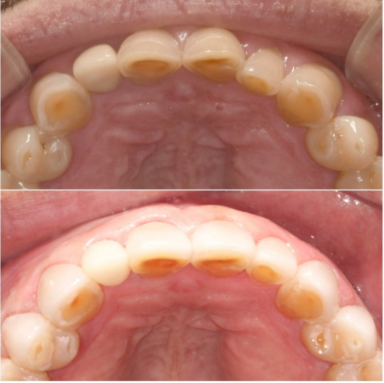 50대 중년교정 무삭제 라미네이트 중년 부분교정 후기 관련 이미지 10