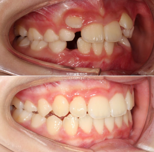 어린이 무턱 성장교정 덧니 인비절라인 퍼스트 악궁확장 치료기간 2년 관련 이미지 29