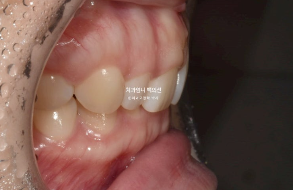 거미스마일 과개교합 교정 잇몸돌출 잇몸 비대칭 관련 이미지 4